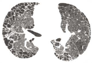 Tubule-on-a-chip comprised of tubes lined with either endothelial or epithelial cells grown together in a 3D channel